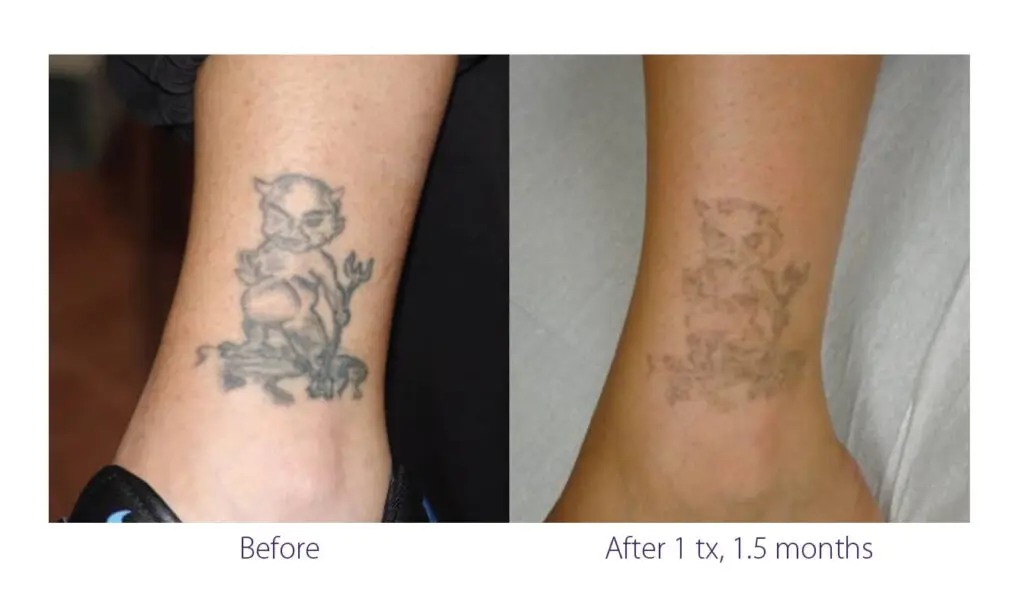 Before and After Alma Harmony Tattoo Removal at Precision Beauty Creations Calgary and Drumheller