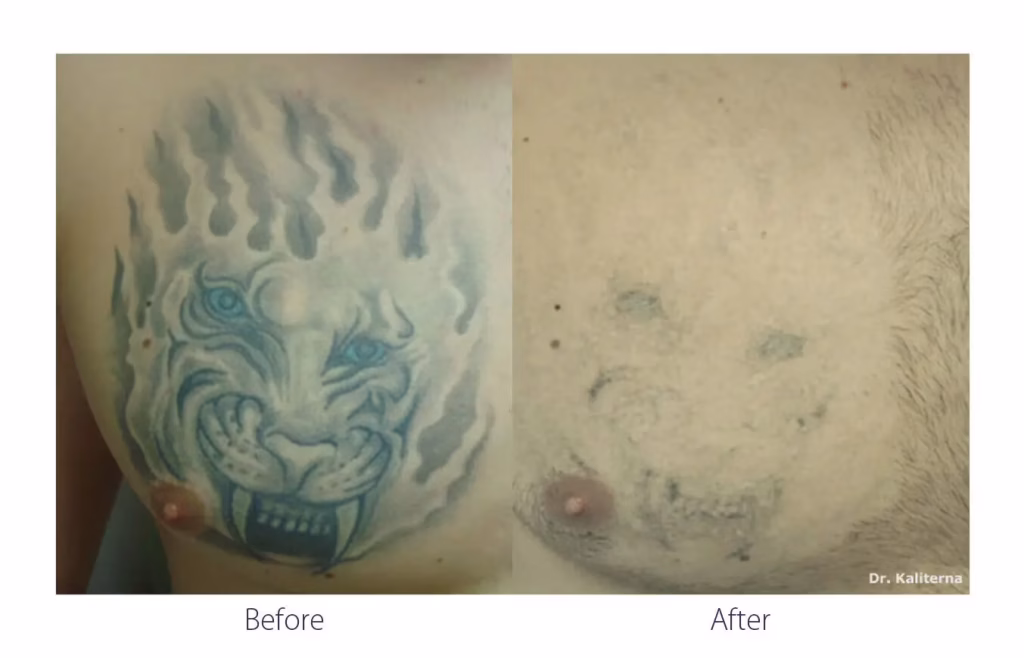 Before and After Laser Tattoo Removal Clinic Drumheller Alberta