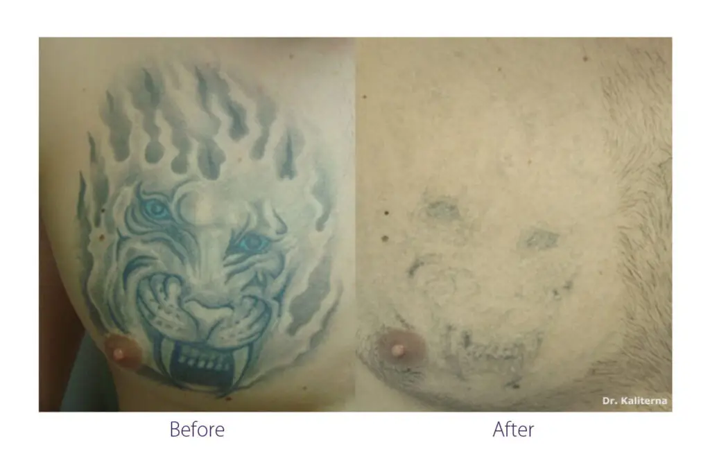 Before and After Alma Harmony Tattoo Removal at Precision Beauty Creations Calgary and Drumheller