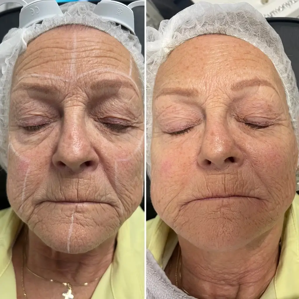 Alma Clearlift Fractional Laser Treatment Skin Rejuvenation - Custom Skin Laser Treatment Skin Rejuvenation Anti-aging fine lines and wrinkles resurfacing brightening before and after