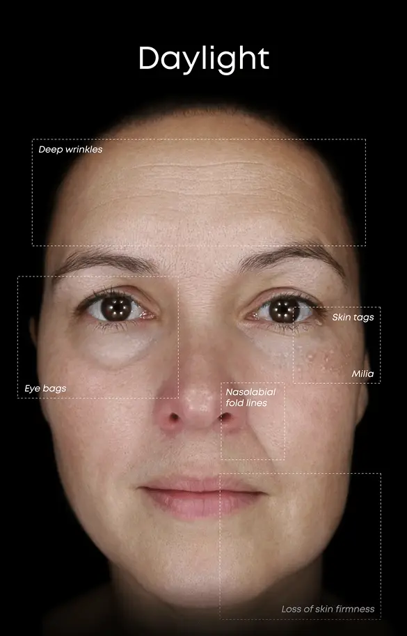 Alma Face IQ Skin Analysis - Custom Skin Laser Treatment Skin Rejuvenation Protocol UV Damage Sun Spots