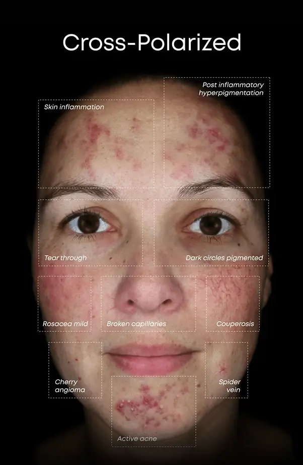 Alma Face IQ Skin Analysis - Custom Skin Laser Treatment Skin Rejuvenation Protocol Rosacea Eczema Psoriasis Acne