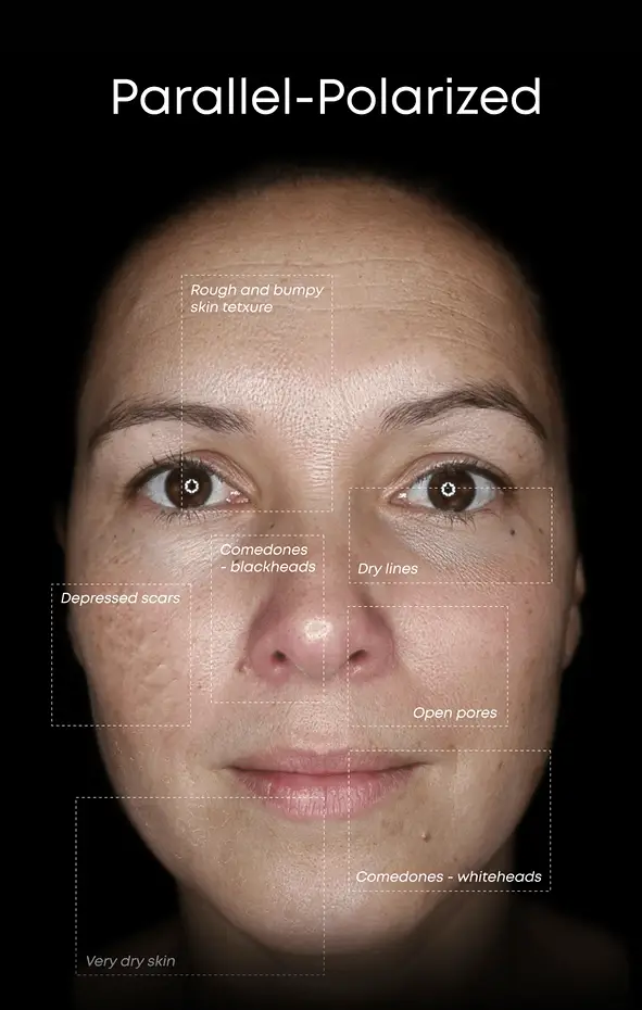 Alma Face IQ Skin Analysis - Custom Skin Laser Treatment Skin Rejuvenation Protocol Fine Lines Wrinkles Textured Skin