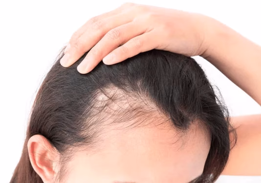 Photo of Woman Seeking Treatments for Thinning Hair and Alopecia